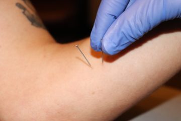 Dry Needling - Acupuncture Treatment in Colorado Springs, CO